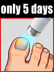 nail laser for Onychomycosis