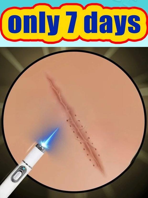 Blue Light Pen Solve Scar